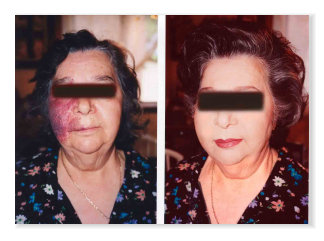 port wine stain coverage, special effects makeup, camouflage makeup